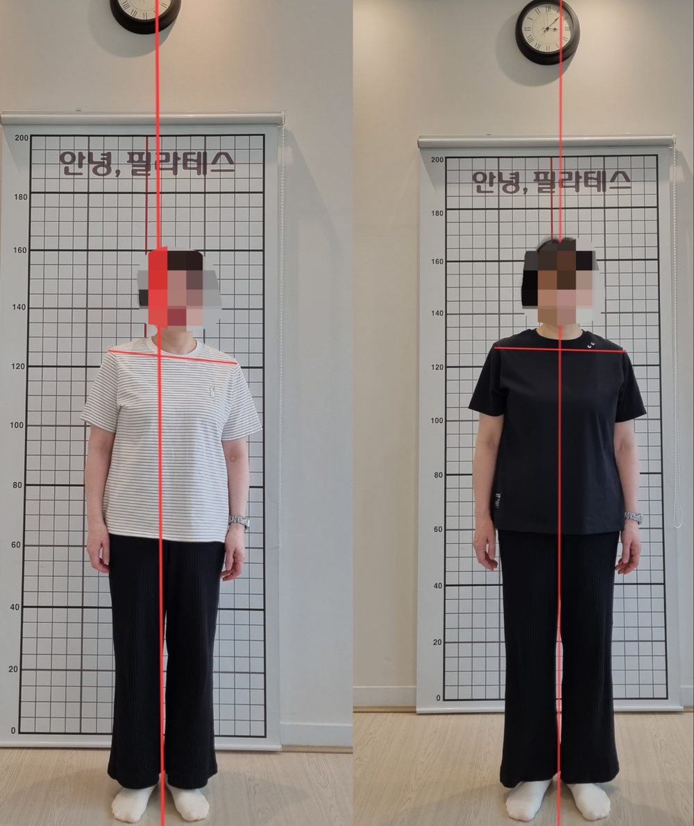 오십견 회원 정면 자세 전후