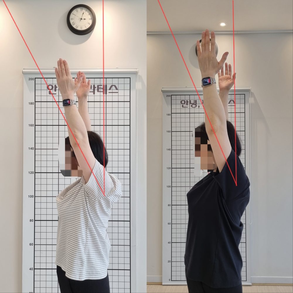 오십견 회원 팔 올리기 전후 비교